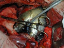 Fasi di Impianto Cuore Artificiale - TAH Implanted