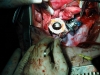 Sutura delle connessioni -Surgical joining of Atrial ports.