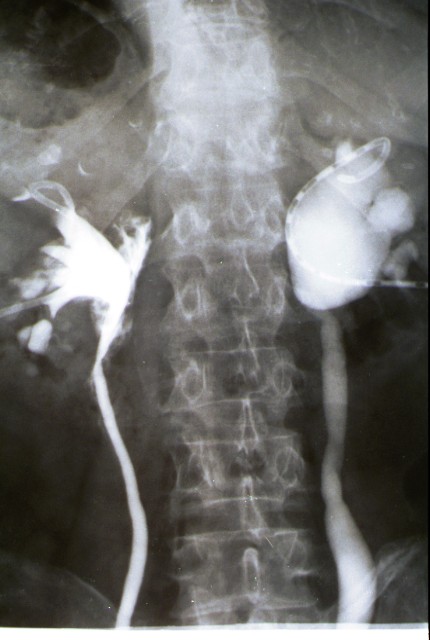 Ispezione con raggi X dei calici renali mediante iniezione di liquido radiopaco attraverso cateteri nefrosromici.